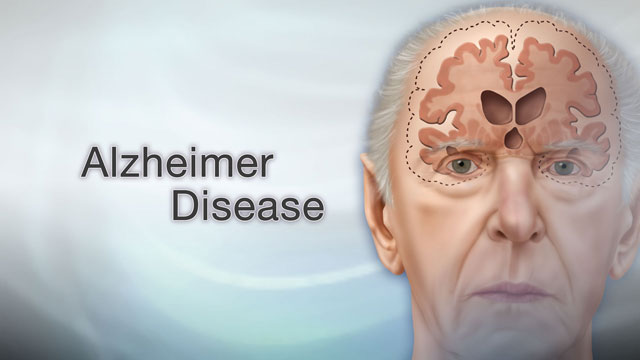 Alzheimers