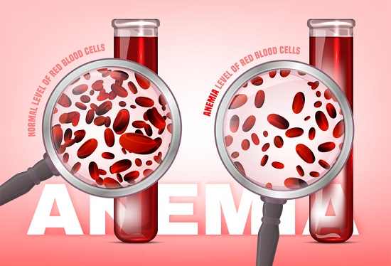 anemia