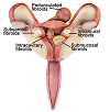 Ayurveda and Gynecology 3 Uterine fibroids are non cancerous tumors arising in the uterus. Seen in the middle and later years of breeding years. - DAD Ayurveda