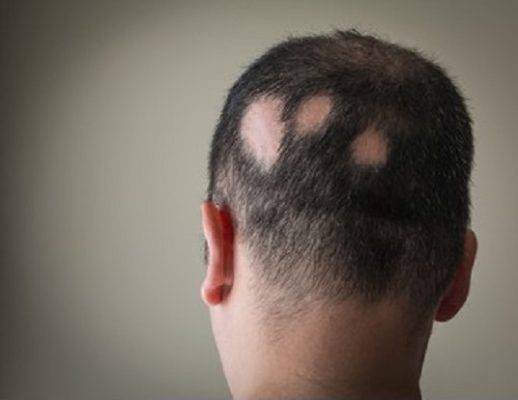 alopecia