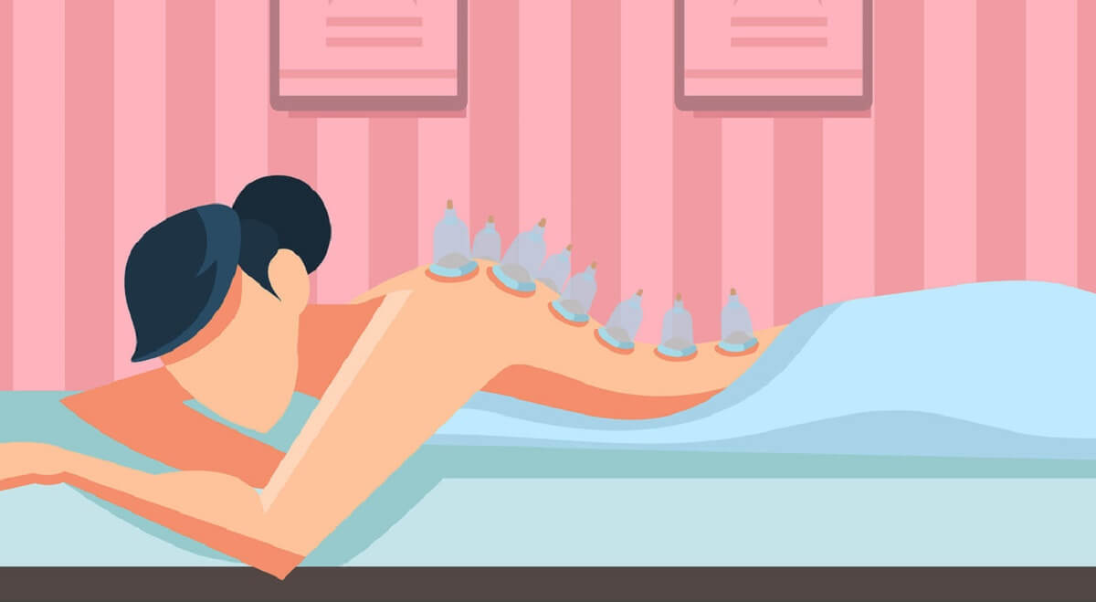 Cupping Therapy