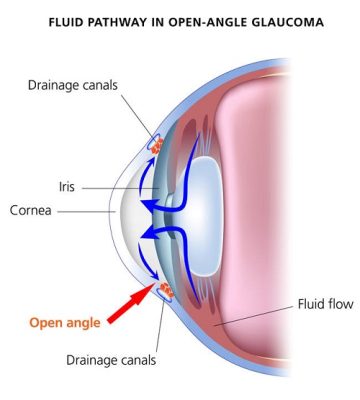 Glaucoma