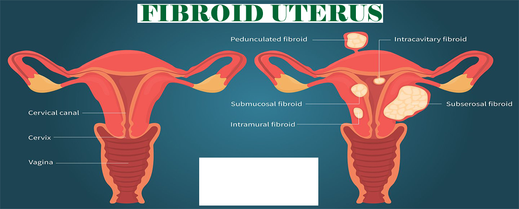 डिम्बग्रंथि कैंसर: प्राकृतिक चिकित्सा प्रतिरोध को दूर कर सकती है