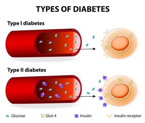 Diabetes Mellitus 10 Types of Diabetes