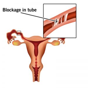 DAD Ayurveda Medicine For Blocked Fallopian Tubes