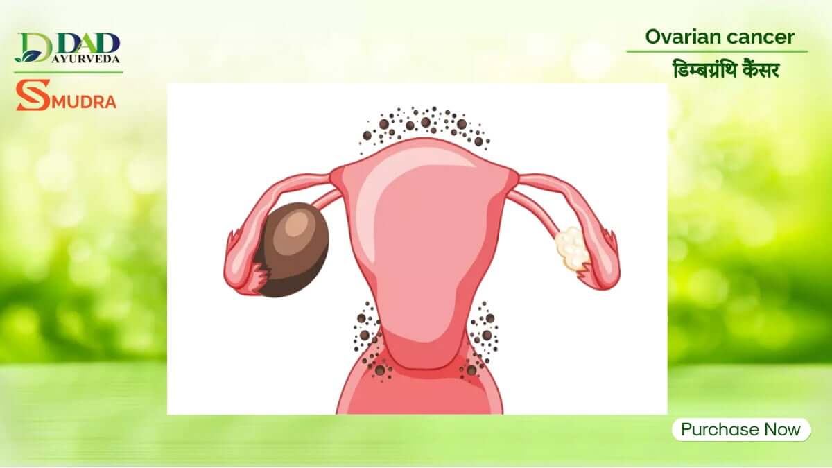 Ovarian Cancer: Naturopathy may overcome resistance