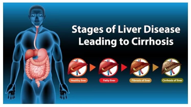 Liver Problems and Their Causes 11 Liver Problems and Their Causes