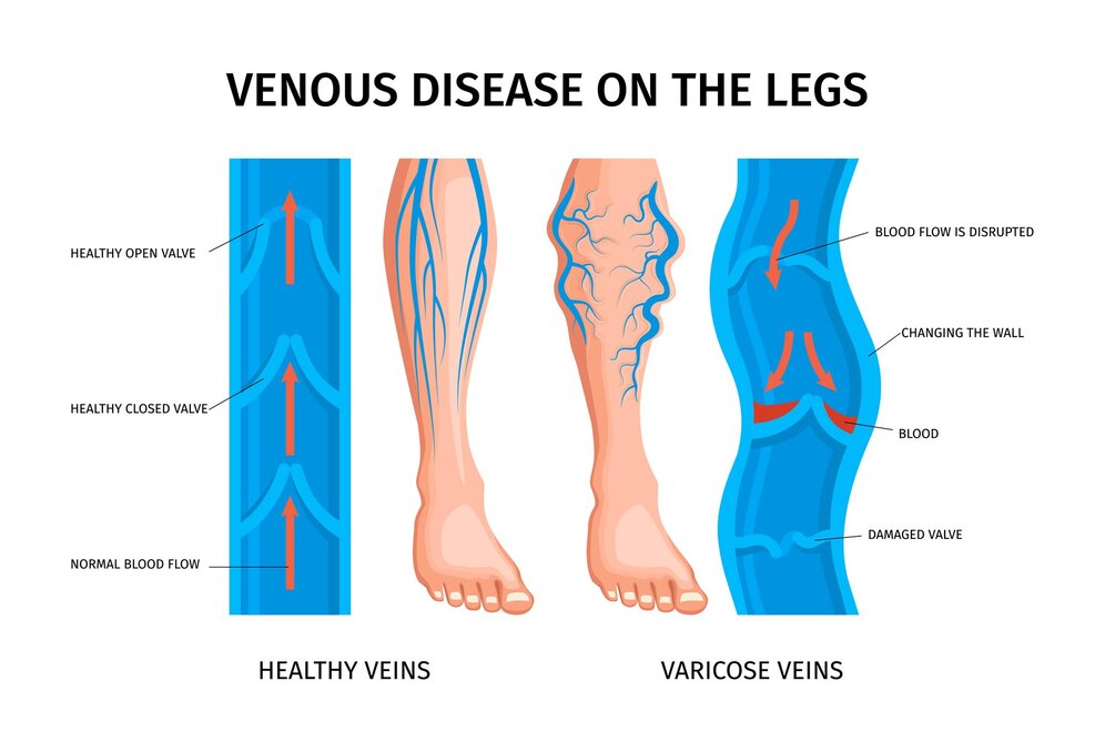 Heals Varicose veins and Spider veins